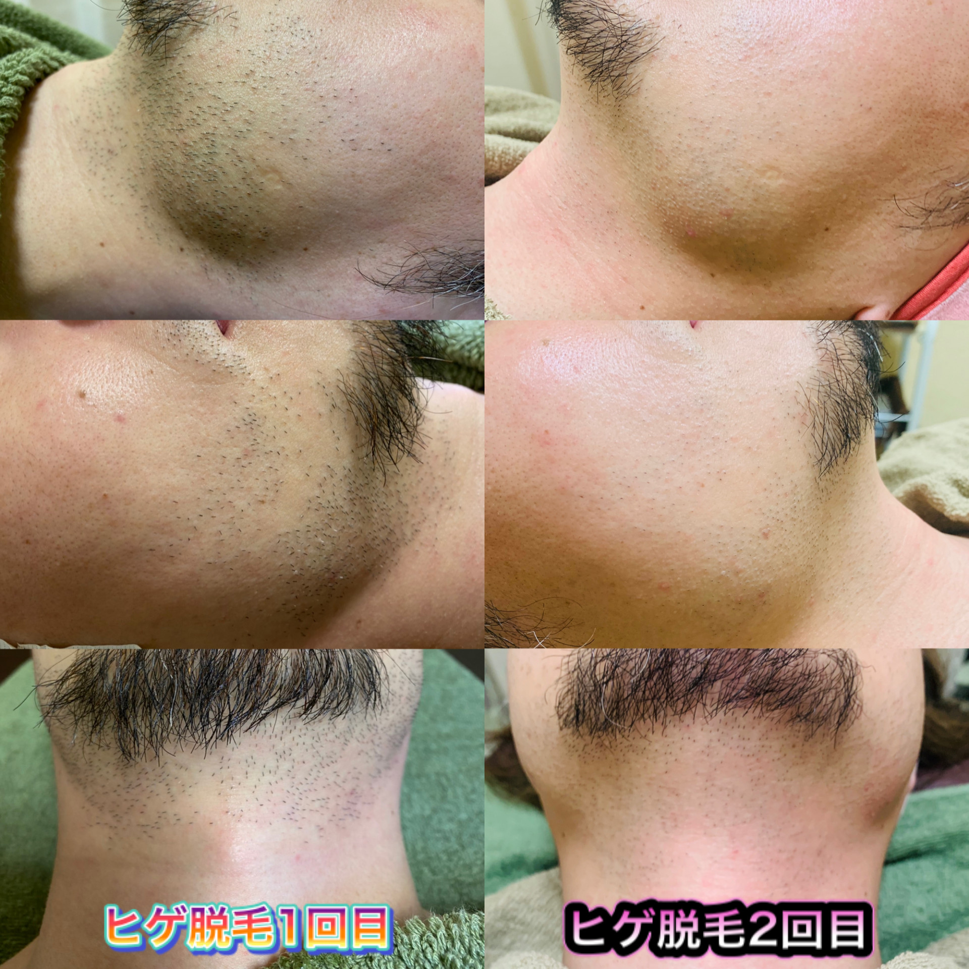 変化写真　ひげ脱毛【Bohe Me shop】