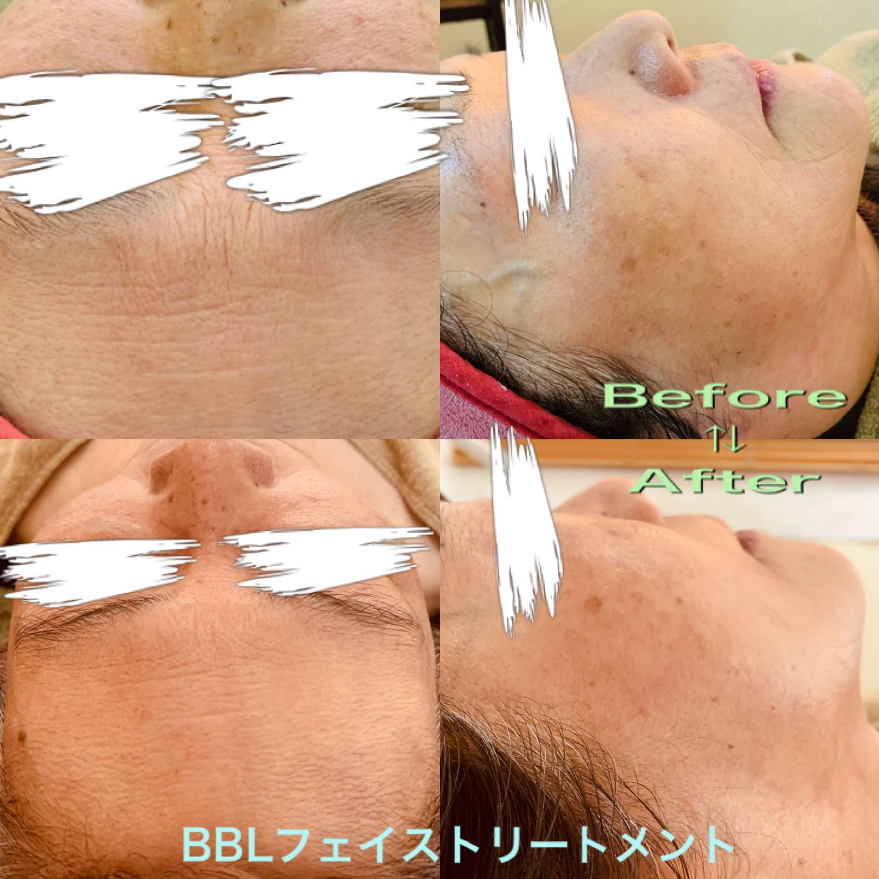 bblﾌｪｲｽﾄﾘｰﾄﾒﾝﾄ  シワでお悩みのお客様【Bohe Me shop】