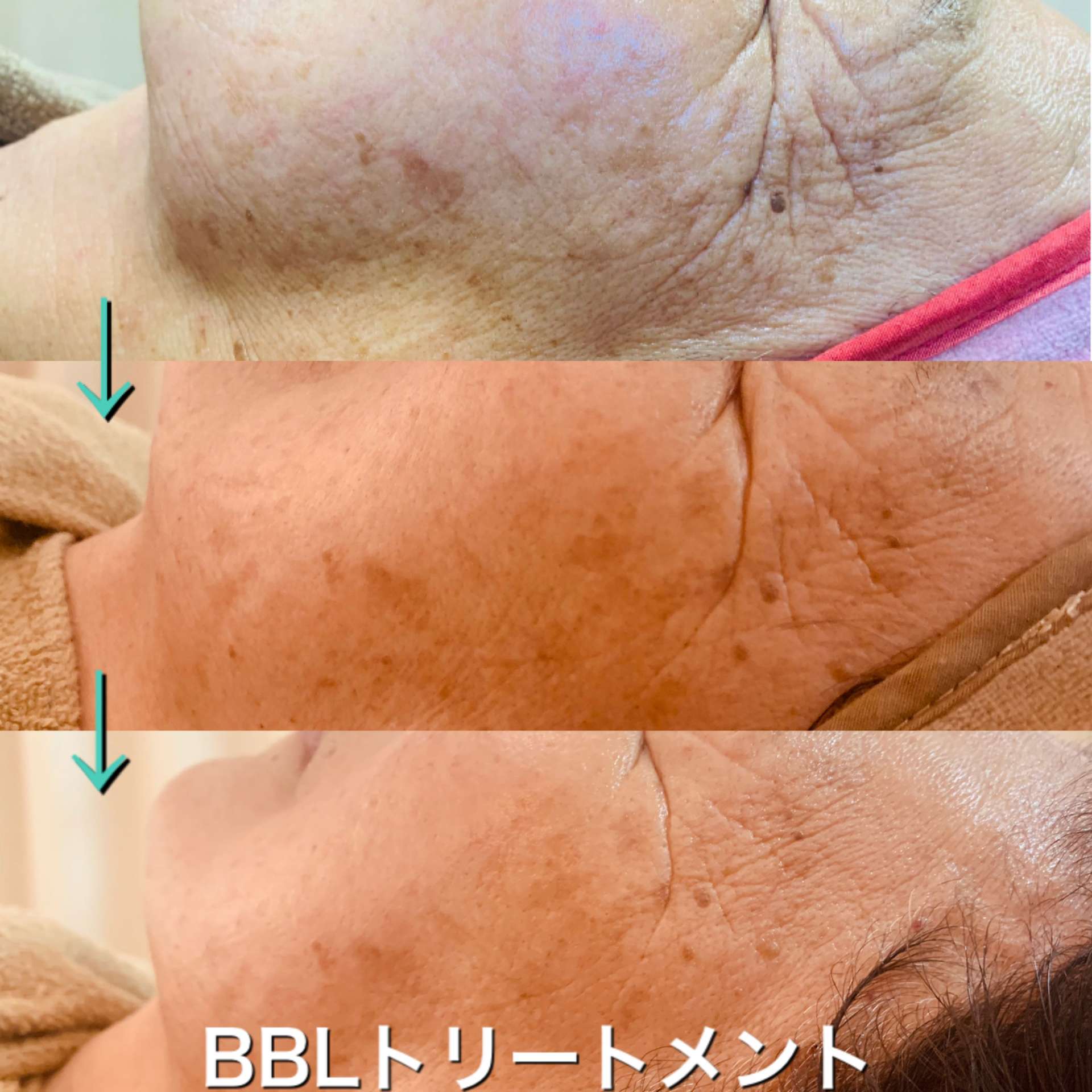 BBLフェイストリートメント【Bohe Me shop】