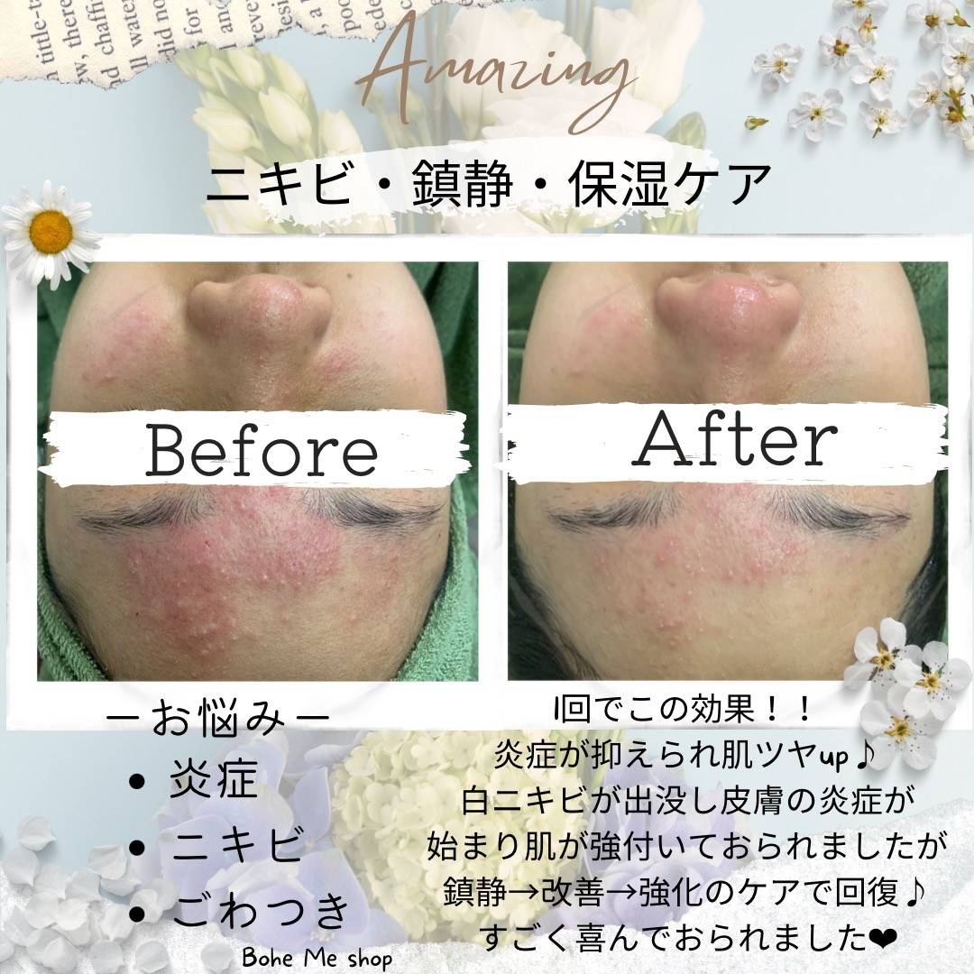 ニキビ鎮静レスキュー【Bohe Me shop】
